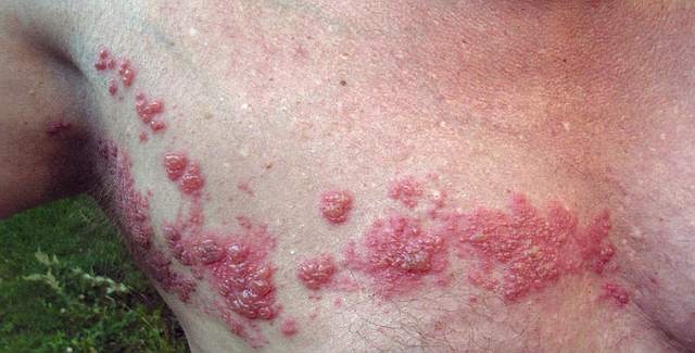 El herpes zoster: los síntomas