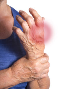 Qué es la artritis gotosa