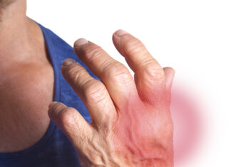 Qué es la artritis gotosa